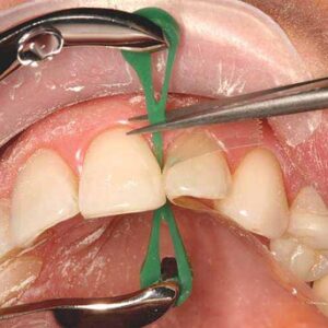 Dental elastic wedges for sectional matrices+ dental installation forceps